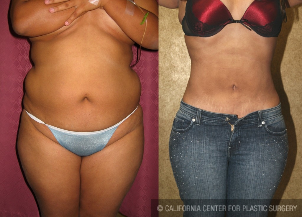 Liposuction Abdomen Medium Before & After Patient #5509