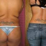 Liposuction Abdomen Medium Before & After Patient #5509