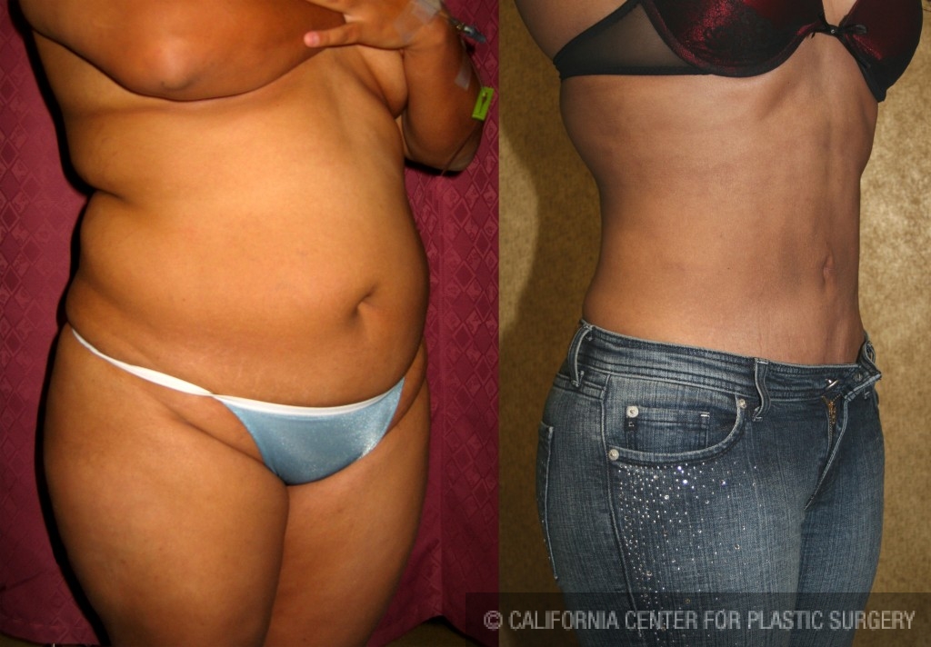 Liposuction Abdomen Medium Before & After Patient #5509