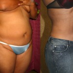 Liposuction Abdomen Medium Before & After Patient #5509