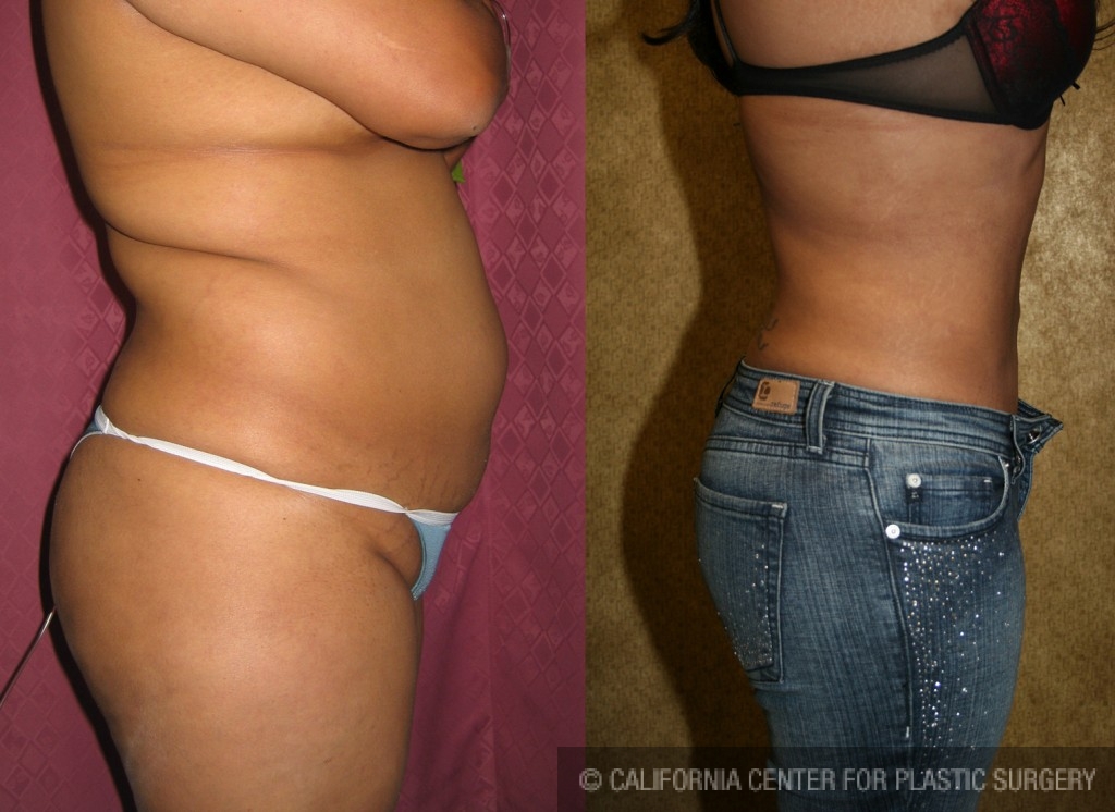 Liposuction Abdomen Medium Before & After Patient #5509