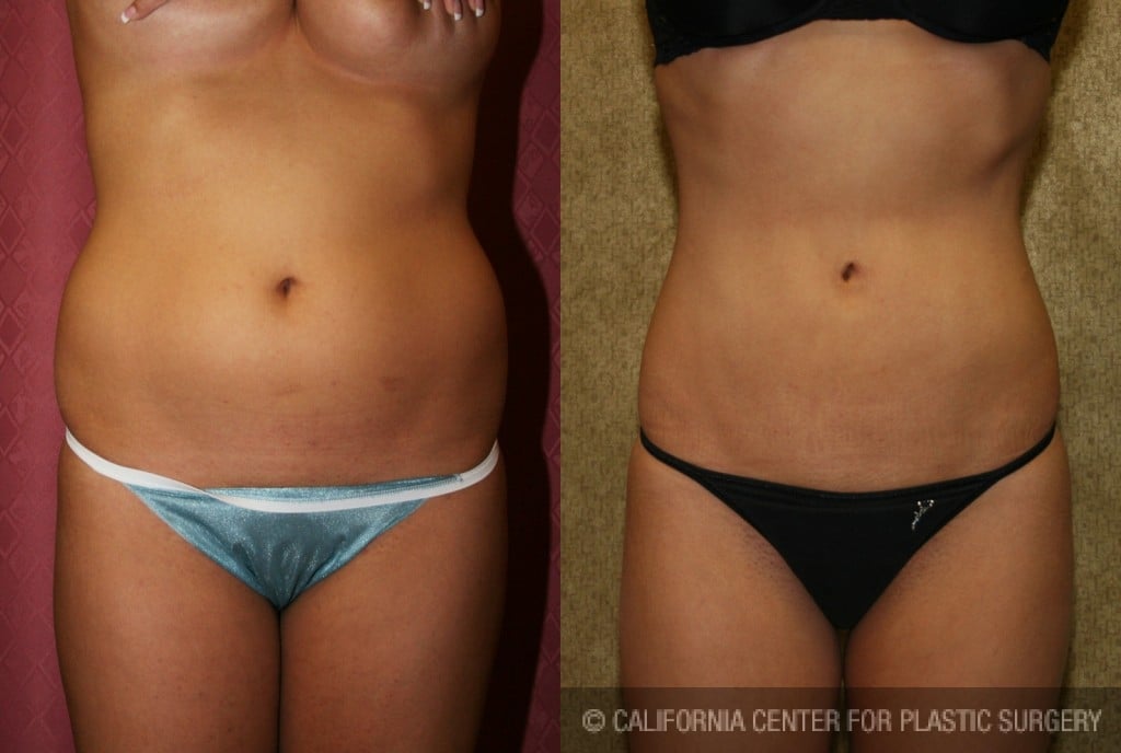 Liposuction Abdomen Medium Before & After Patient #5505