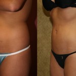 Liposuction Abdomen Medium Before & After Patient #5505