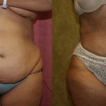 Liposuction Abdomen Plus Size Before & After Patient #5580