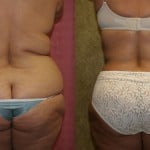 Liposuction Abdomen Plus Size Before & After Patient #5580