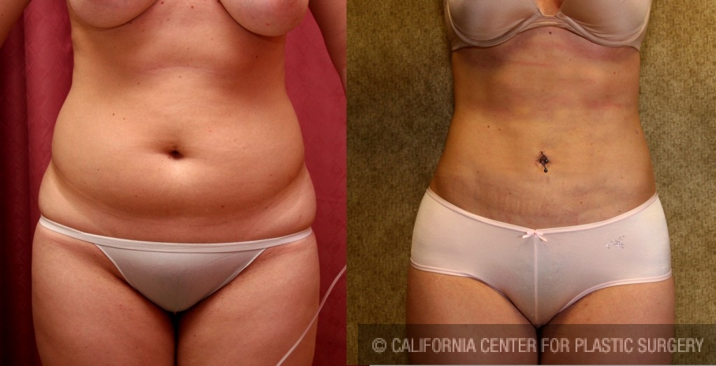 Liposuction Abdomen Medium Before & After Patient #5522