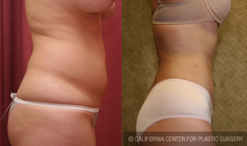 Liposuction Abdomen Medium Before & After Patient #5522