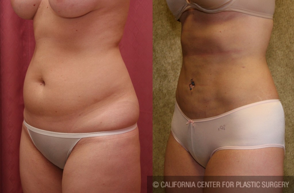 Liposuction Abdomen Medium Before & After Patient #5522