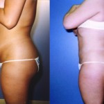 Liposuction Abdomen Medium Before & After Patient #5541