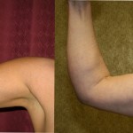 Liposuction Arms Before & After Patient #5709