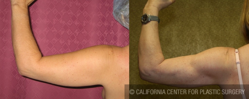 Liposuction Arms Before & After Patient #5709