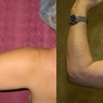 Liposuction Arms Before & After Patient #5709