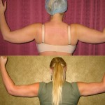 Liposuction Arms Before & After Patient #5686