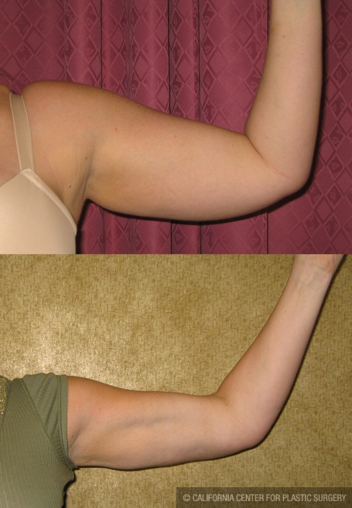 Liposuction Arms Before & After Patient #5686