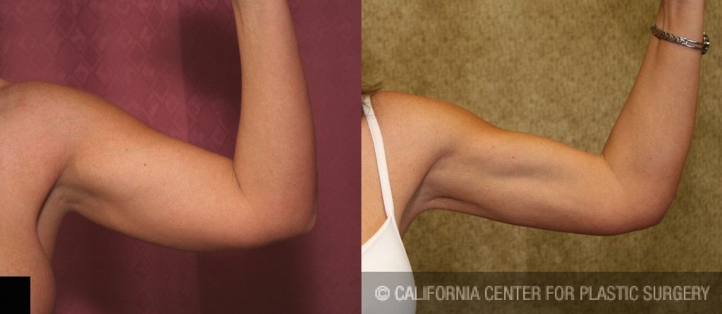 Liposuction Arms Before & After Patient #5695