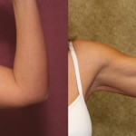 Liposuction Arms Before & After Patient #5695