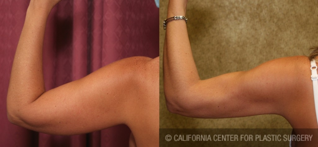 Liposuction Arms Before & After Patient #5695