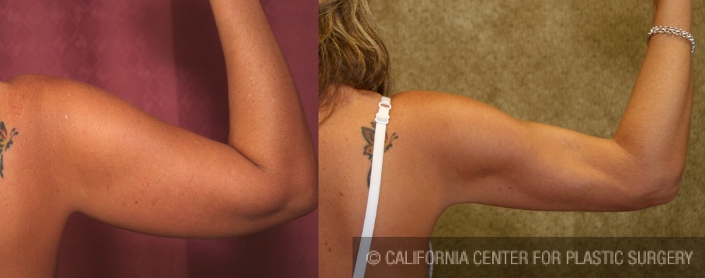 Liposuction Arms Before & After Patient #5695