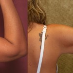 Liposuction Arms Before & After Patient #5695