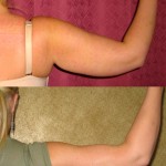 Liposuction Arms Before & After Patient #5686