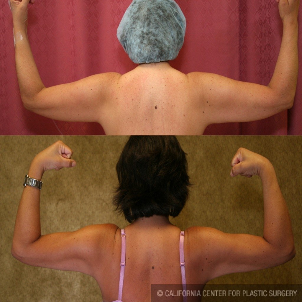 Liposuction Arms Before & After Patient #5704