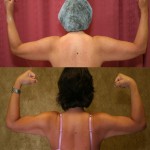 Liposuction Arms Before & After Patient #5704