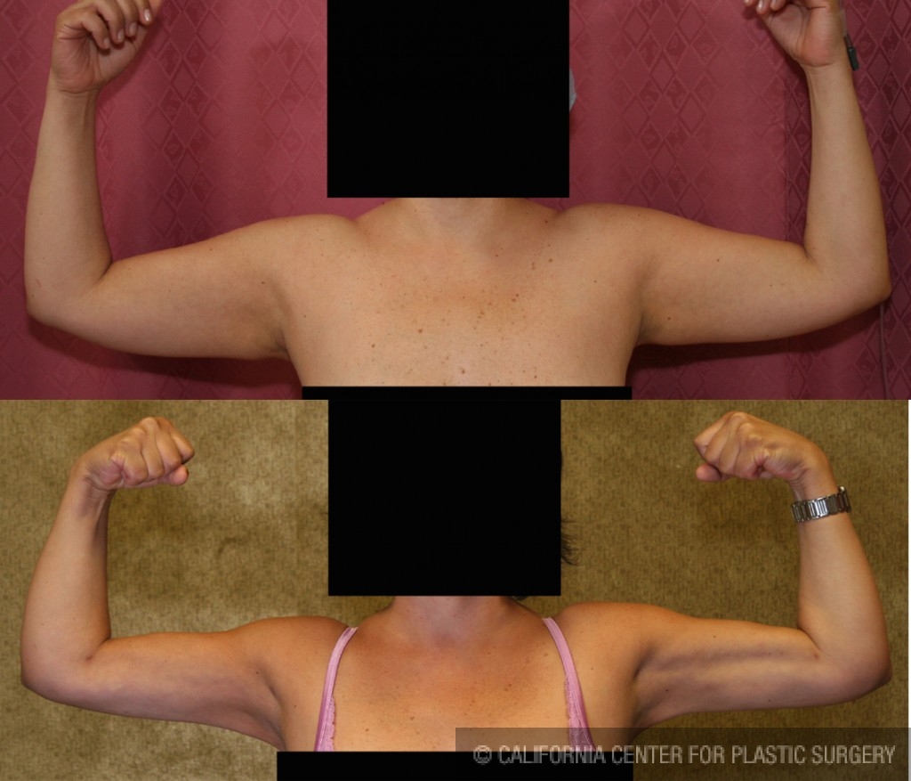 Liposuction Arms Before & After Patient #5704