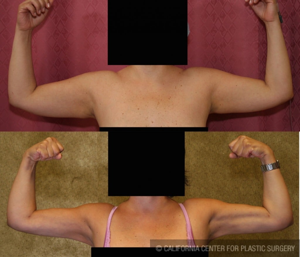 Liposuction Arms Before & After Patient #5704