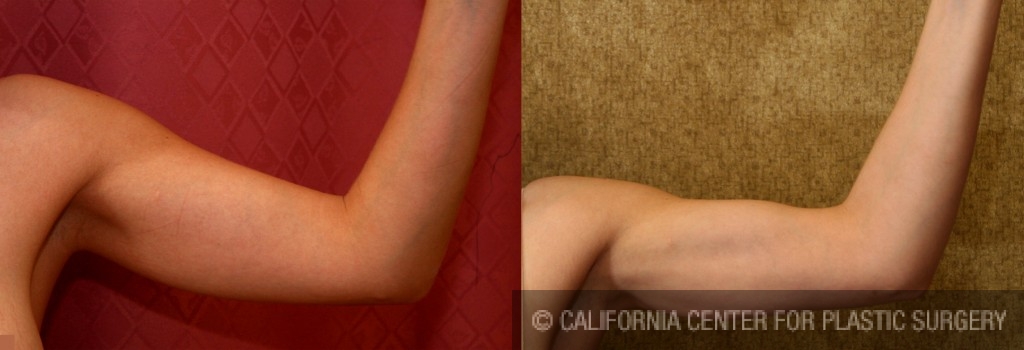 Liposuction Arms Before & After Patient #5690