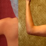 Liposuction Arms Before & After Patient #5690