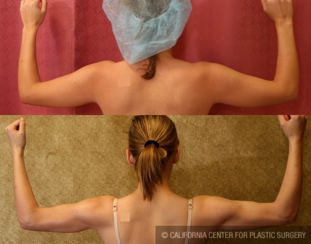 Liposuction Arms Before & After Patient #5690