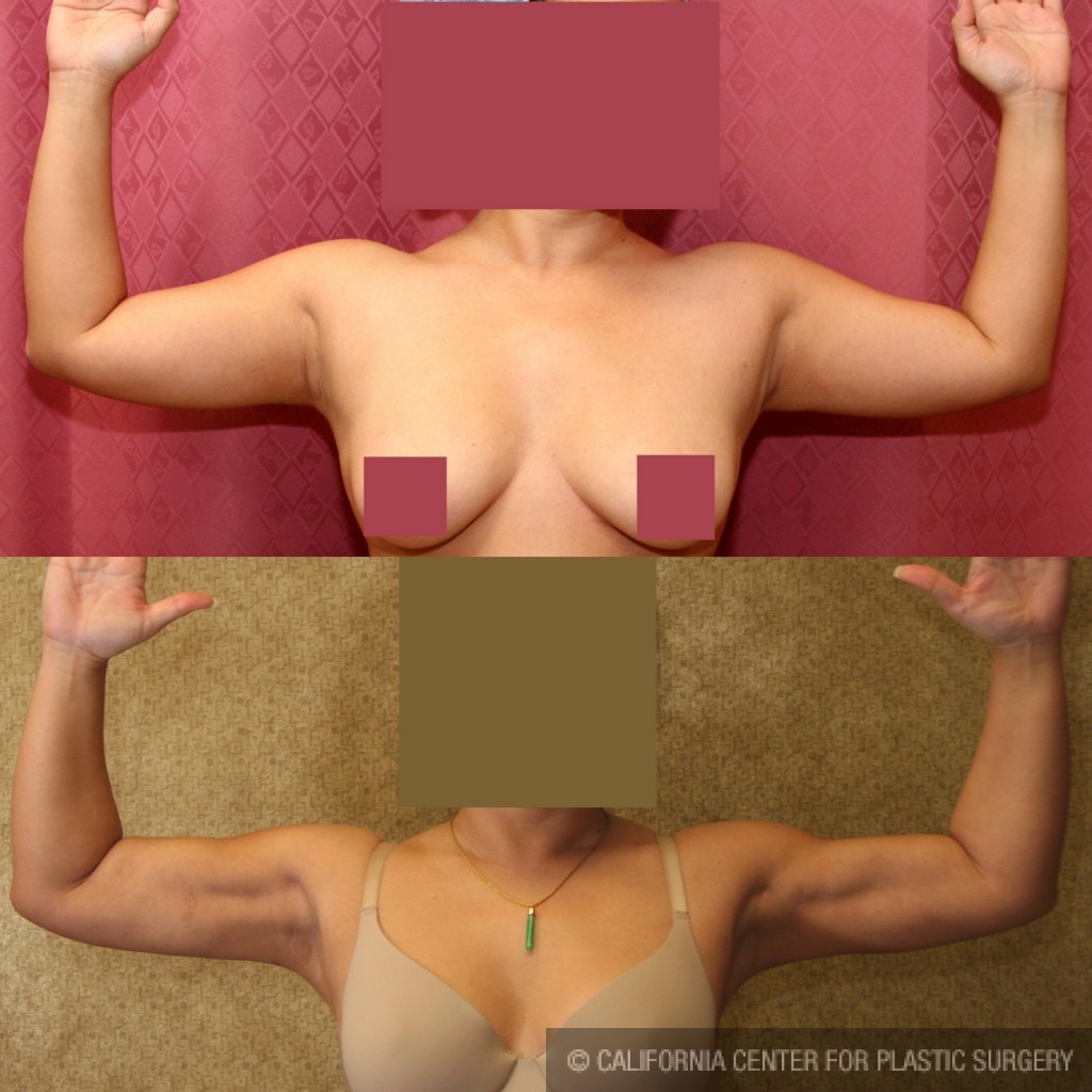 Liposuction Arms Before & After Patient #9489