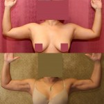 Liposuction Arms Before & After Patient #9489