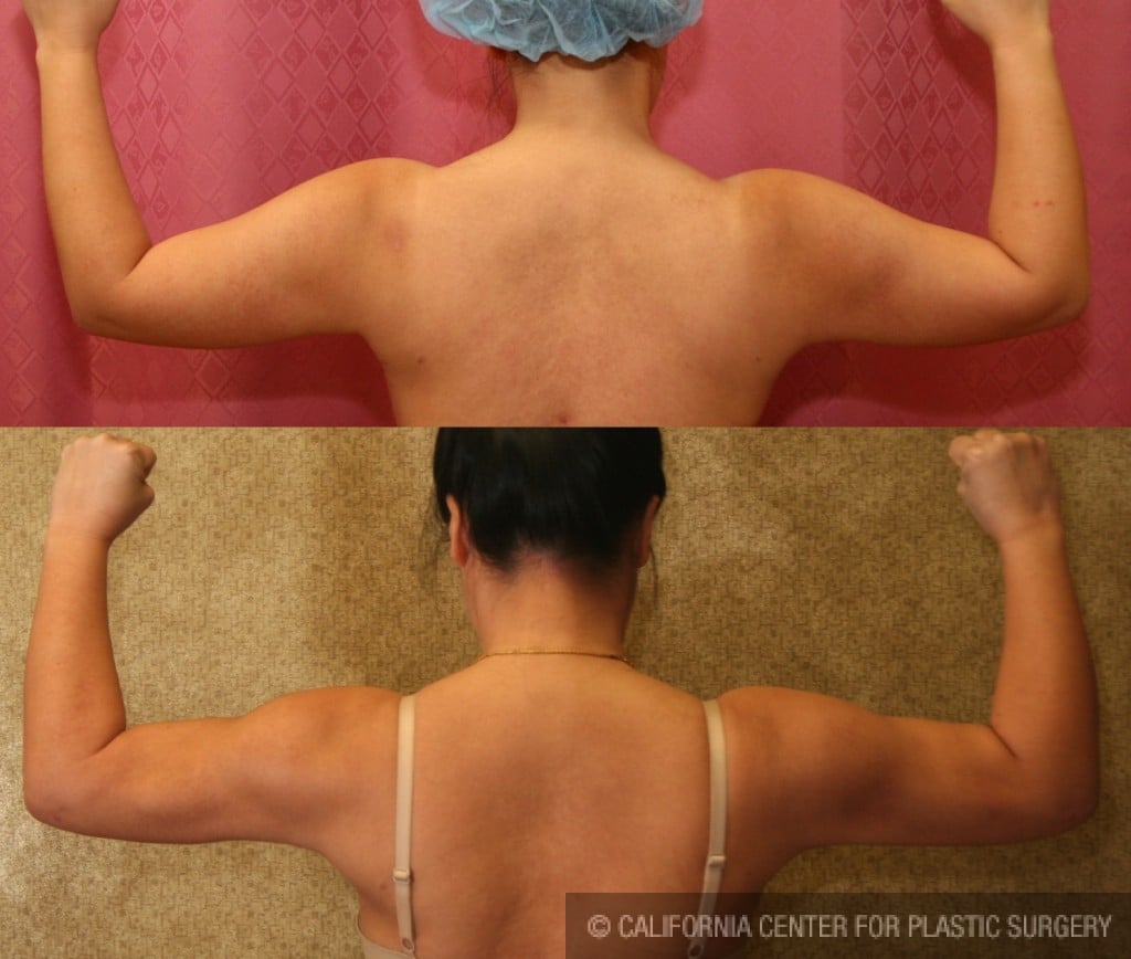 Liposuction Arms Before & After Patient #9489