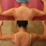 Liposuction Arms Before & After Patient #9489