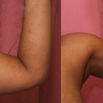 Liposuction Arms Before & After Patient #5715