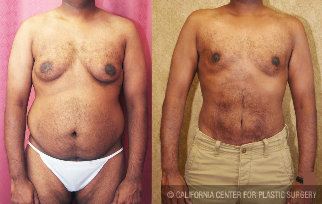 Male Liposuction Abdomen Before & After Patient #5675