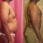 Male Liposuction Abdomen Before & After Patient #5675