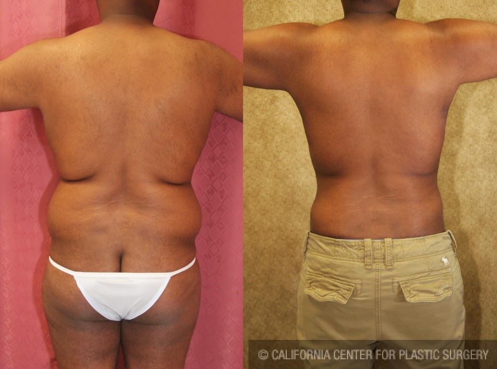 Male Liposuction Abdomen Before & After Patient #5675