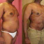 Male gynecomastia (breast) reduction Before & After Patient #6805