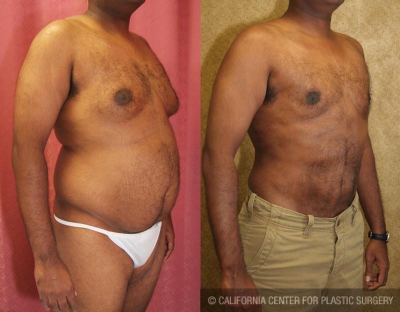 Male gynecomastia (breast) reduction Before & After Patient #6805