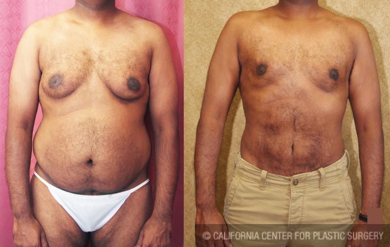 Male gynecomastia (breast) reduction Before & After Patient #6805