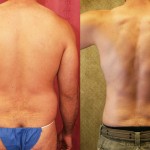 Male Liposuction Abdomen Before & After Patient #5680