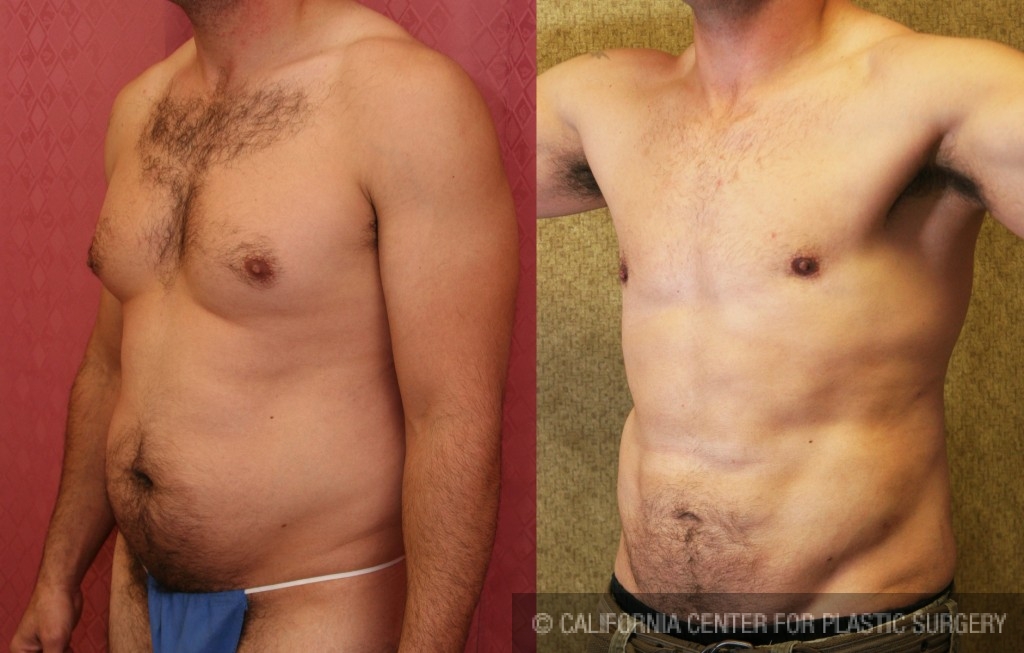 Male Liposuction Abdomen Before & After Patient #5680