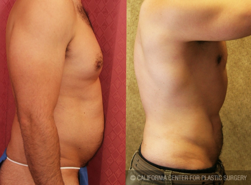 Male Liposuction Abdomen Before & After Patient #5680