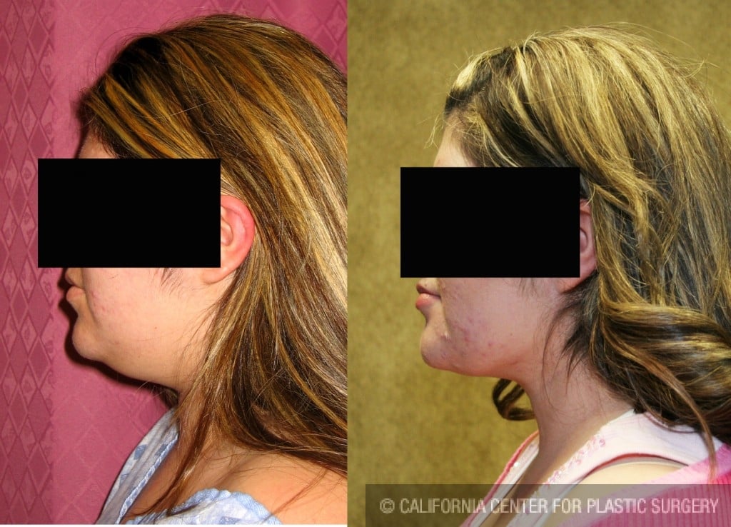 Neck & Face Liposuction Before & After Patient #6654