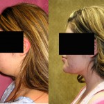 Neck & Face Liposuction Before & After Patient #6654