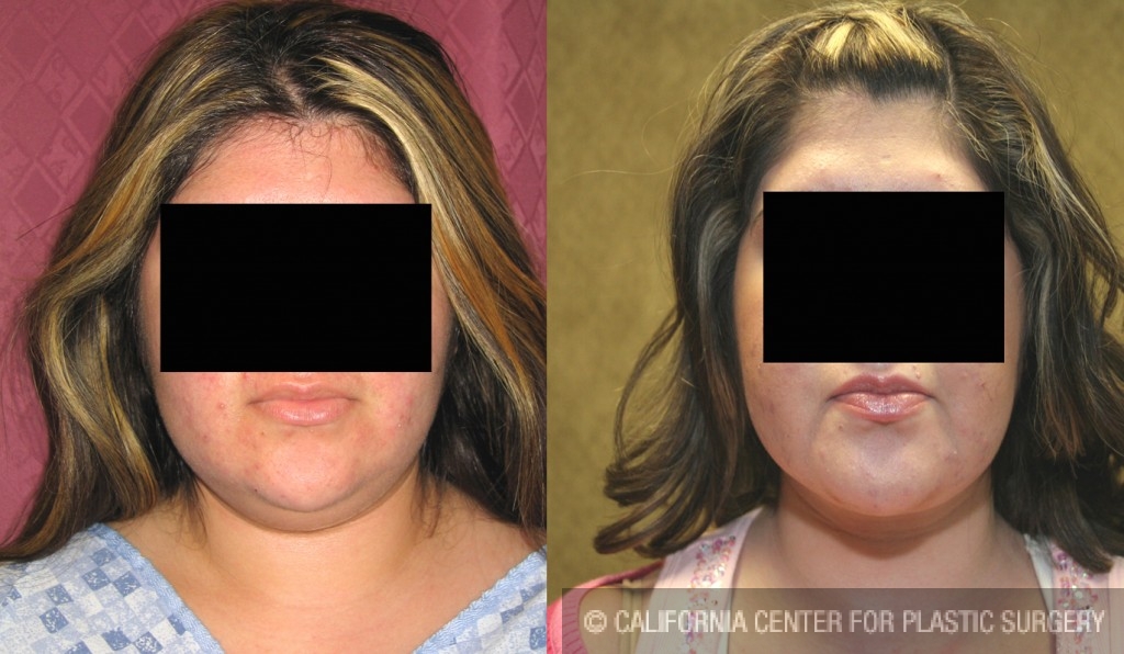 Neck & Face Liposuction Before & After Patient #6654