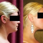 Neck & Face Liposuction Before & After Patient #6609