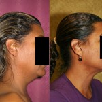 Neck & Face Liposuction Before & After Patient #6659